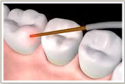 Illustration of a dental procedure